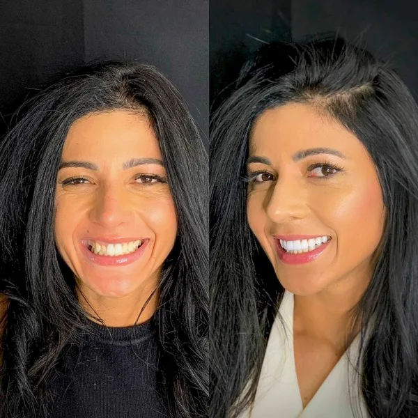Paciente da Inova Implantes antes e depois das lentes de contato dental
